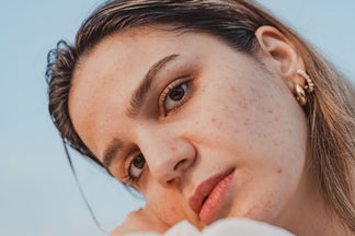 Say Goodbye to Acne: Understanding Your Skin and Finding the Right Treatment